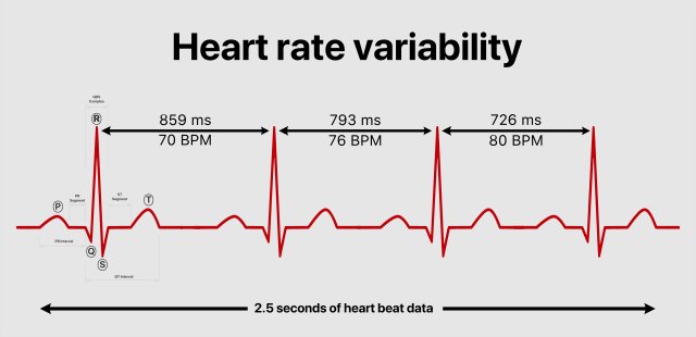 A measurement of heart rate variability (HRV) showing the different millisecond intervals between each heart beat. HRV measurements are helpful for people with Long Covid.