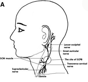 Location of a stellate ganglion block on side of neck. Possible treatment for Long Covid. Licenced under Creative Commons